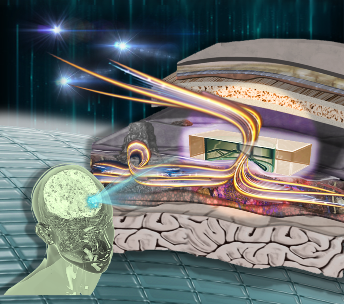 illustration of how a device in the brain works as treatment for hydrocephalus